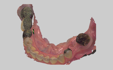 写真：口腔内スキャナーによるデジタルデータの取得