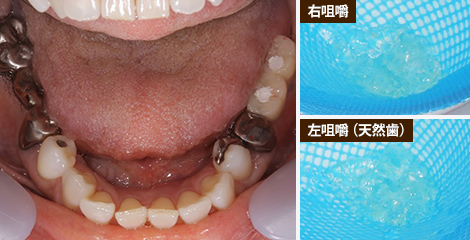 写真：治療後の咀嚼力110mg/dL、左（天然歯）は198mg/dL