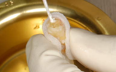 写真：抜歯した歯から病巣をとる