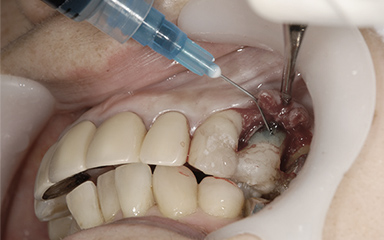 写真：エムドゲインを用いて歯周病の改善